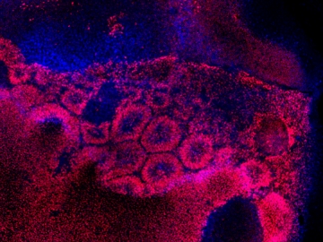 Human embryonic stem cells differentiating into precursors cells of the retina. Nuclei are in blue. Pink indicates the presence of Pax6, a protein found in retinal tissue. The retinal pigment epithelium is the tissue responsible for macular degeneration, the most common cause of blindness. 