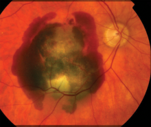retinal scan in patient with wet age related macular degeneration