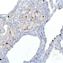 Immunohistochemistry: Ki67 on polycystic kidney disease