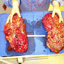 Polycystic kidneys from ADPKD patient